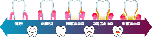 歯周病進行図